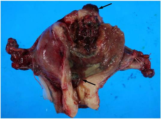 Endometrioid Adenocarcinoma With High Grade Transformation