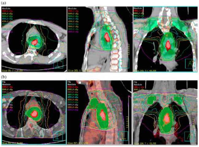 What Is the Appropriate Clinical Target Volume for