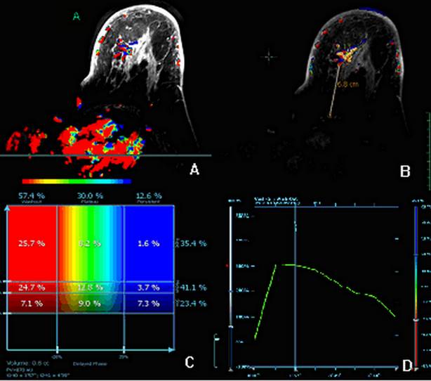 3.0T MR-CAD: Clinical Value in Diagnosis of Breast Tumor ... diagram serial 